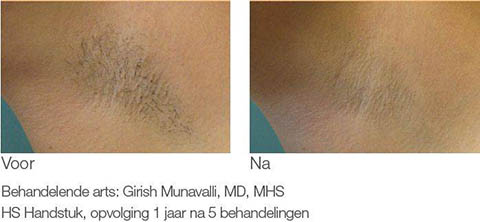 Laserbehandeling oksels voor na