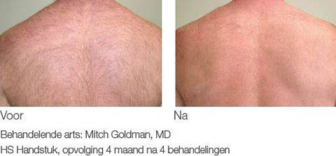 Laserbehandeling rug voor na